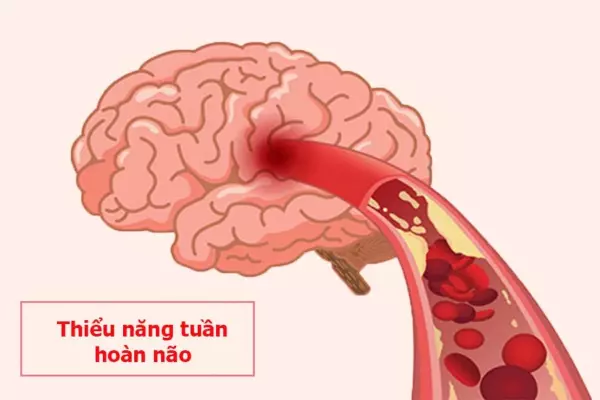Thiểu năng tuần hoàn não và 6 điều cần biết để não luôn đủ máu